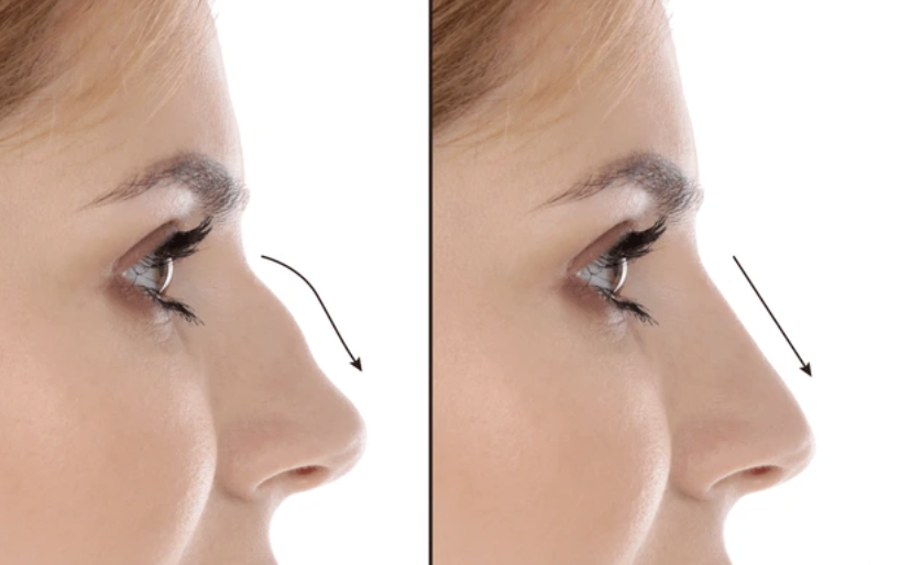 Rinomodelação sem cirurgia para corrigir imperfeições no nariz com ácido hialurónico em Setúbal.