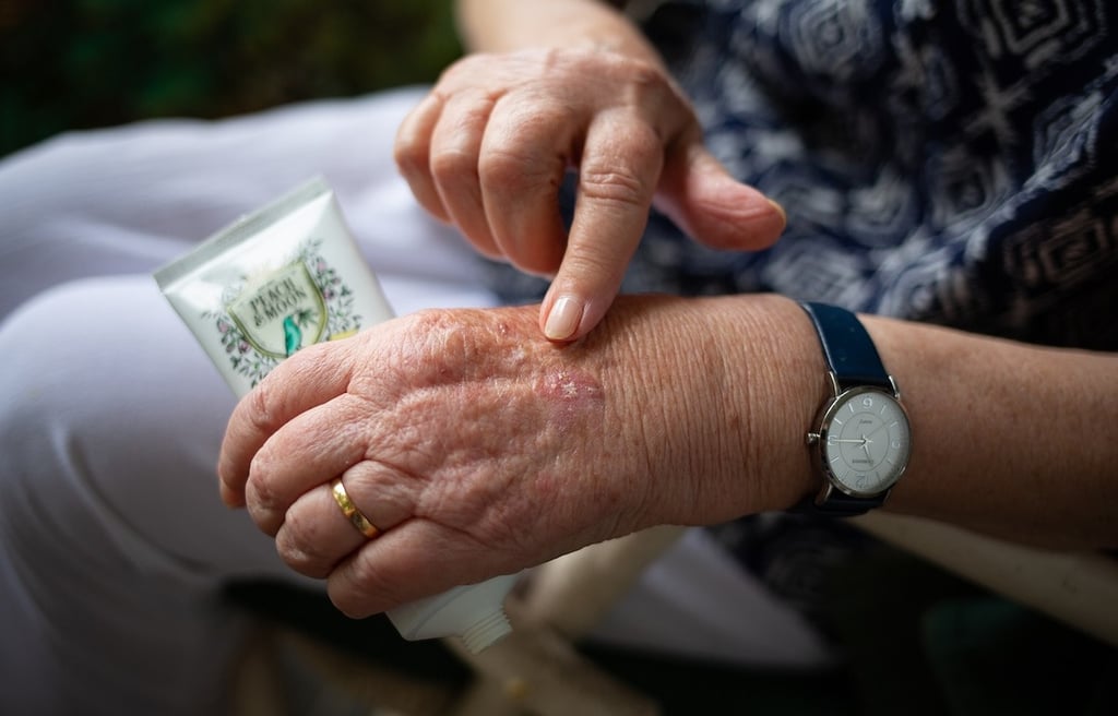 Older woman applying cream on her swollen hand.