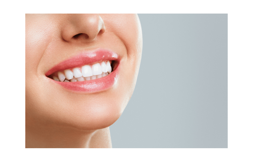 Close-up of a smiling woman with white, perfectly aligned teeth, showcasing a successful cosmetic de