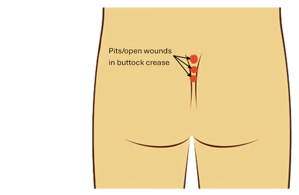 Diagram showing pilonidal cyst pits and open wounds located in the buttock crease.