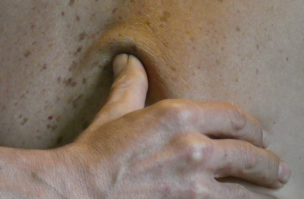 un térapeuthe exerce un impulsion vibratoire sur un trigger point