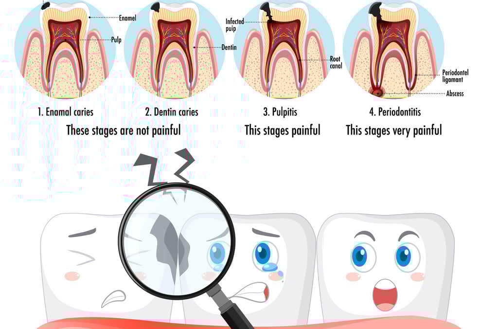 What is Tooth Decay?