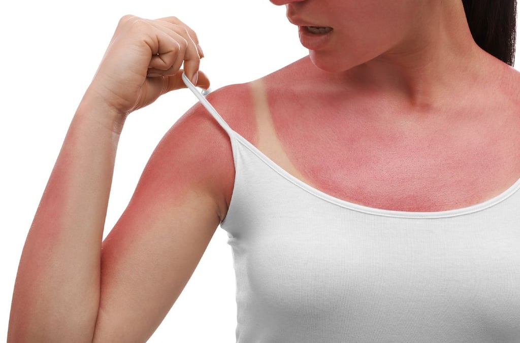 Dealing with Sunburns