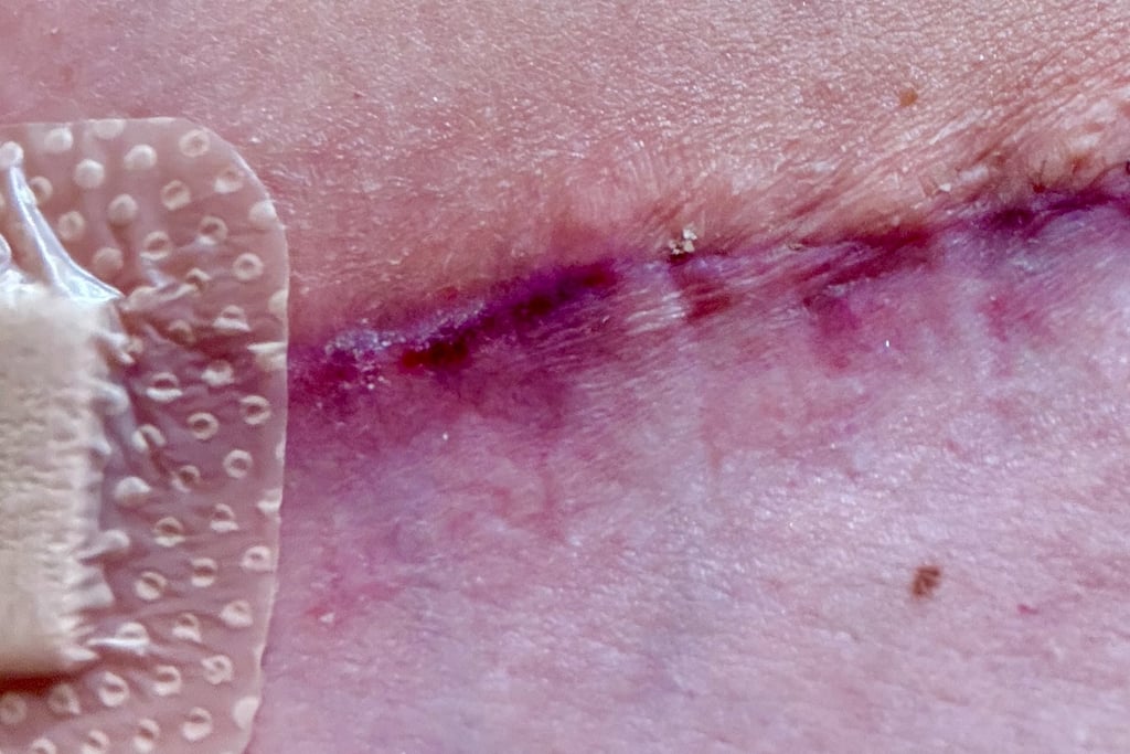 Red inflamed scar after DIEP surgery