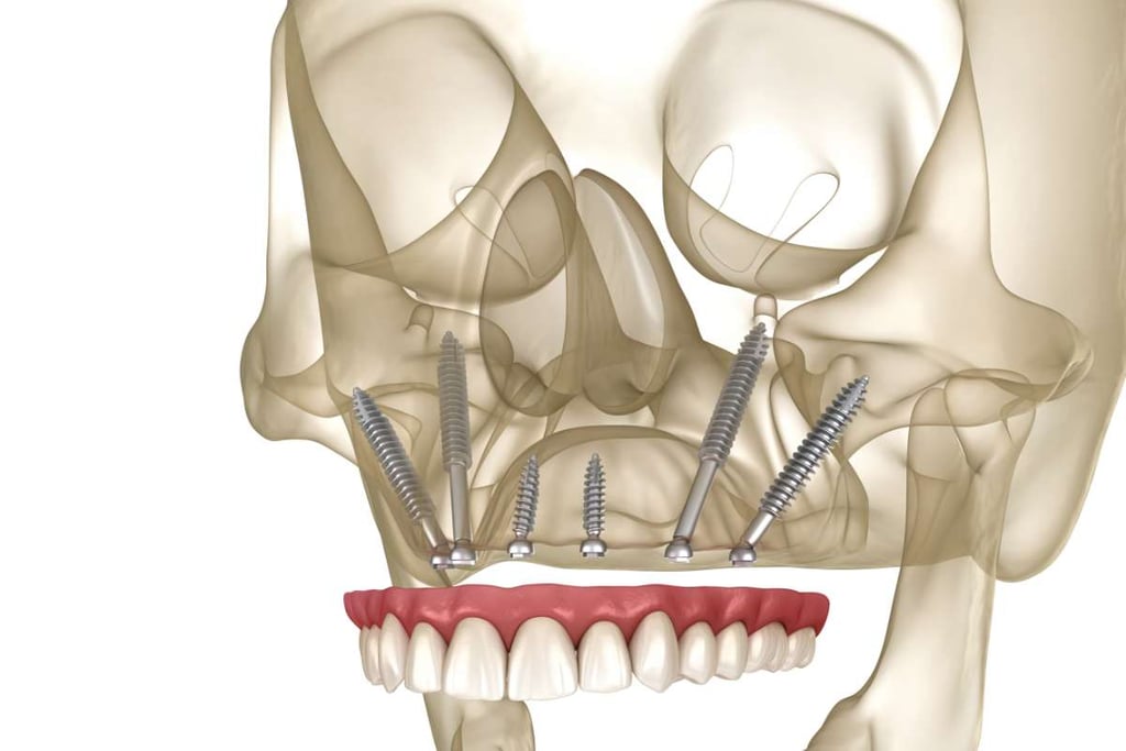implantes cigomaticos