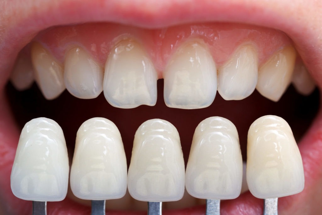 fatete dentare protetica coroane punte lucrare proteza