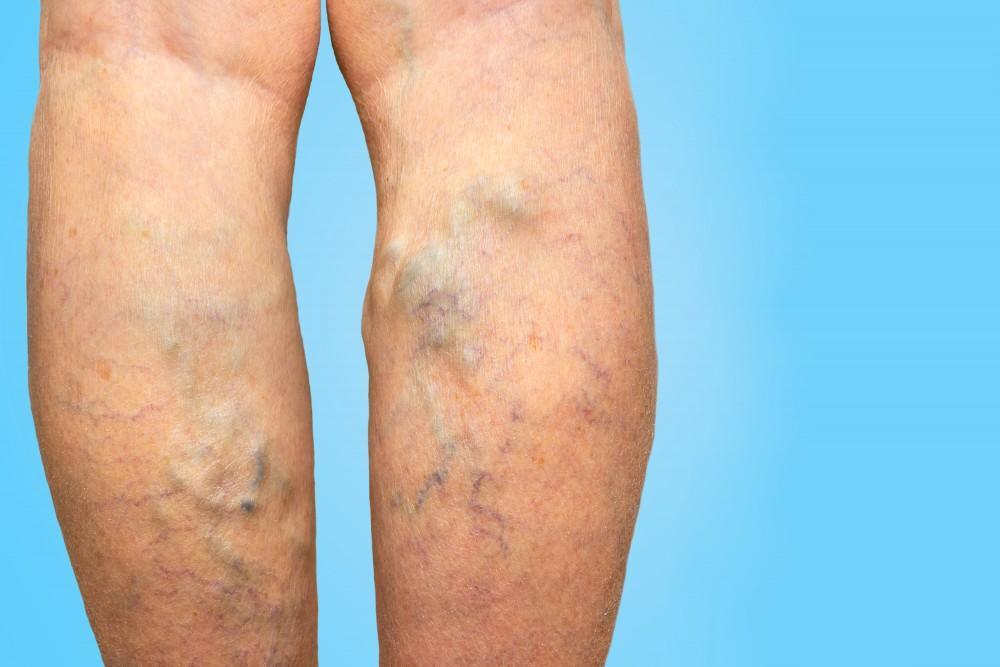 vascular ultrasound varicose vein swelling pain sclerotherapy leg ulcer radiofrequency laser ablation insufficiency chronic