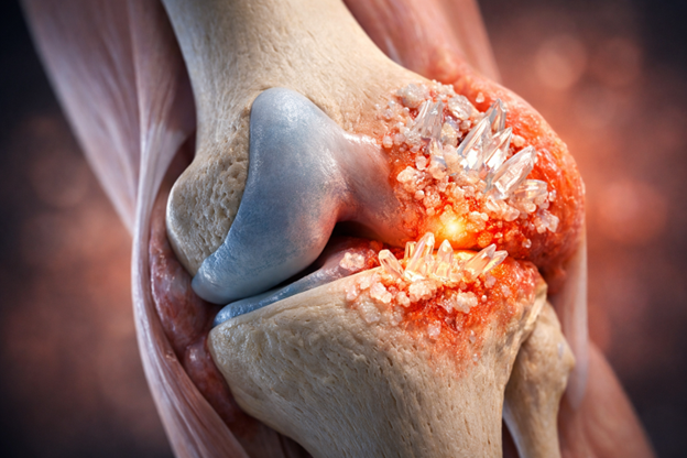 Figura 1 — Depósito de cristais de urato em articulação (Render 3D; imagem gerada pelo Nutro AI).