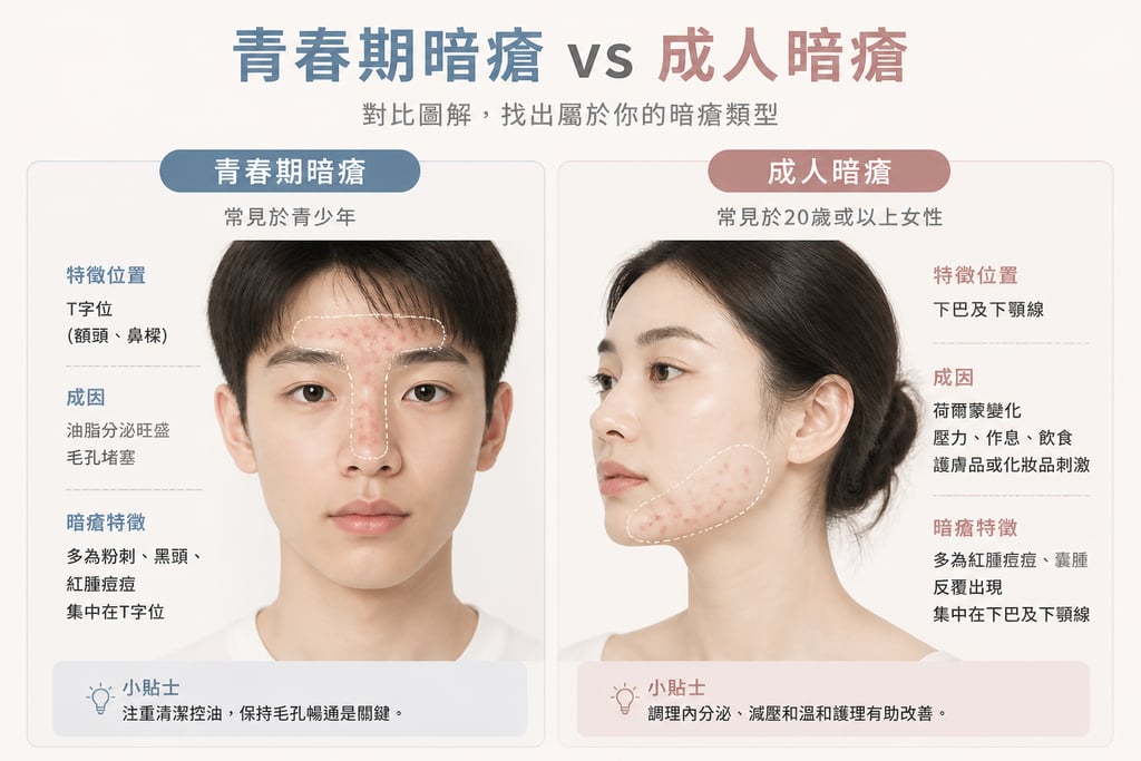 青春期暗瘡 vs 成人暗瘡對比圖