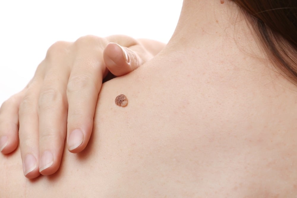 Mole and skin lesion expert assessment in Durham and Darlington at Ash Plastic surgery
