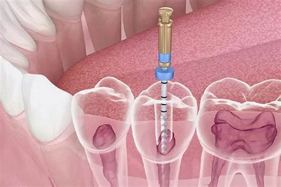 Trattamento-endodontico-devitalizzazione