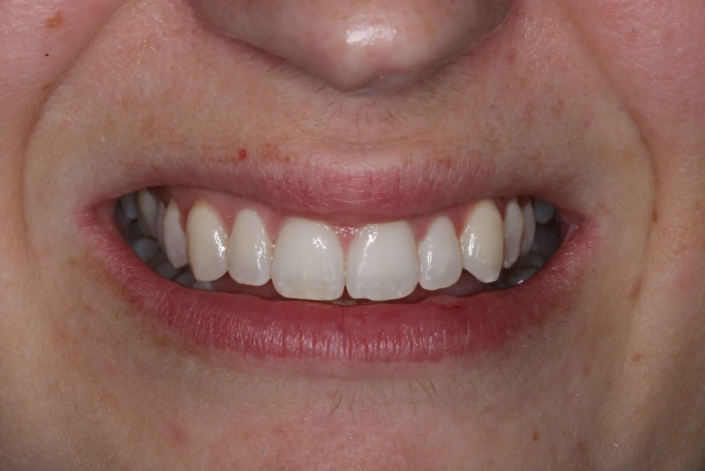 a close up of a person's teeth after invisalign aligner treatment