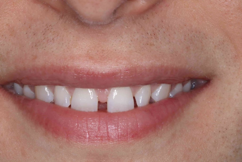 a close up of a person's mouth with mis aligned teeth