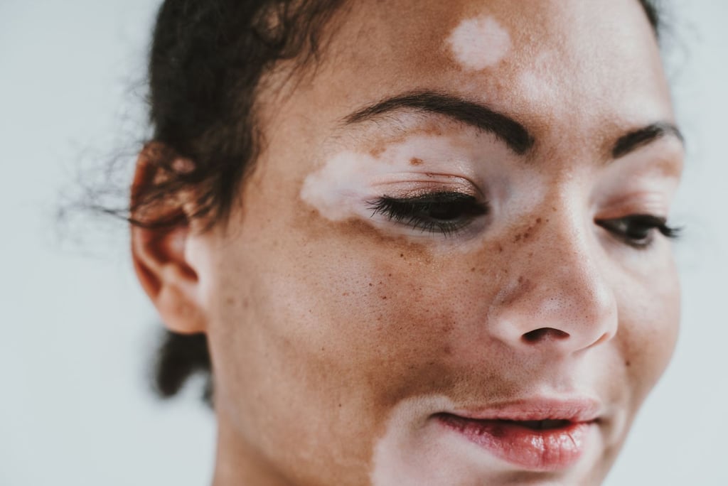 Vitiligo treatment in Vadodara: Find the best skin clinic near you for effective treatment options
