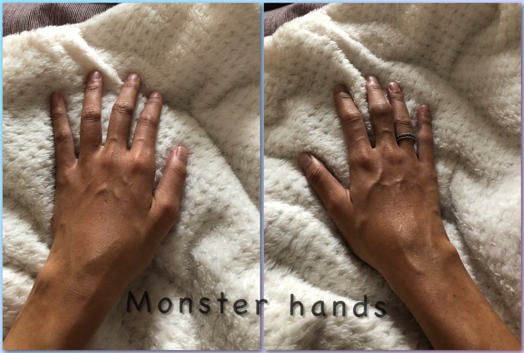 rheumatoid arthiritis hands