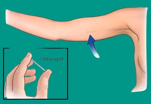 implant contraceptif, contraception, anti grossesse, recherchesante.com (1)