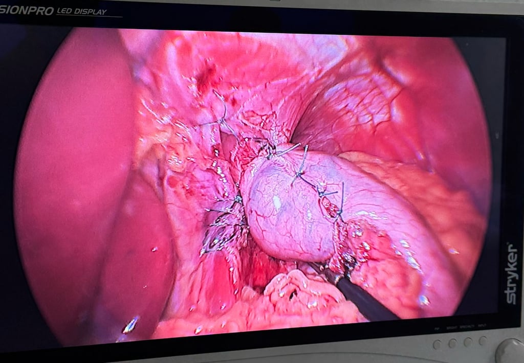 fotografia que mostra cirurgia de refluxo