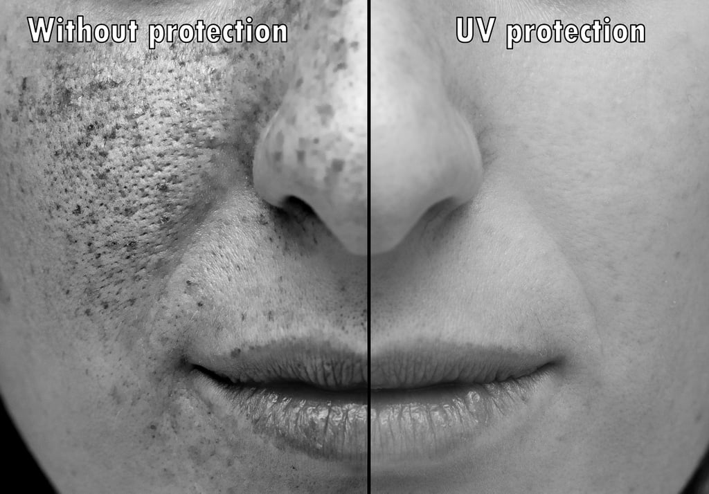 Sunburn: Symptoms & Treatment