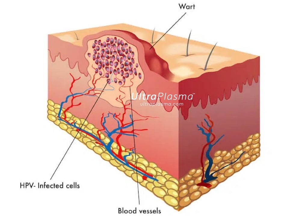 ultraplasma.com_wart_treatment_sigil_tedavisi_ultra_plasma_ultra_plazma_verruca vulgaris