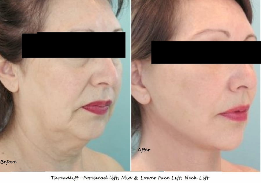 Non-surgical thread lift with fillers and fat reduction, results on 50-year-old woman.