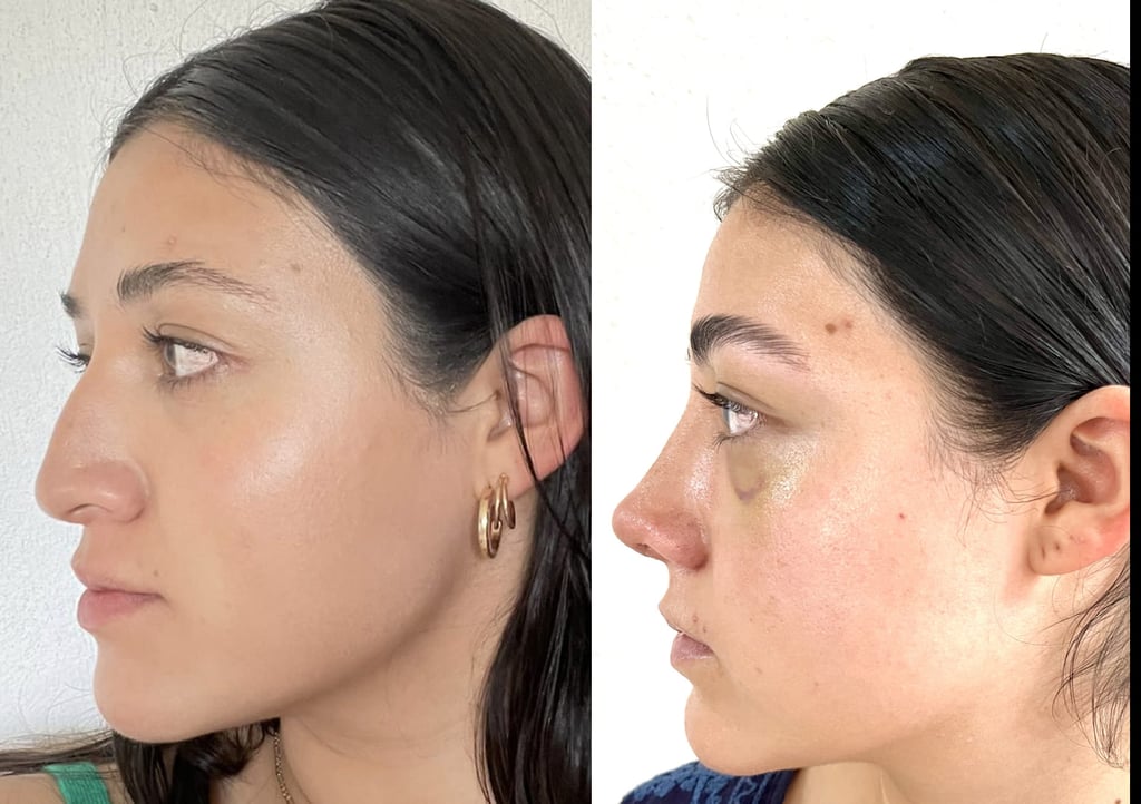 Perfil lateral antes y después de la rinoplastia, mostrando los resultados del remodelado de nariz