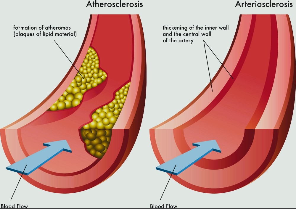 Arteriosclerosis