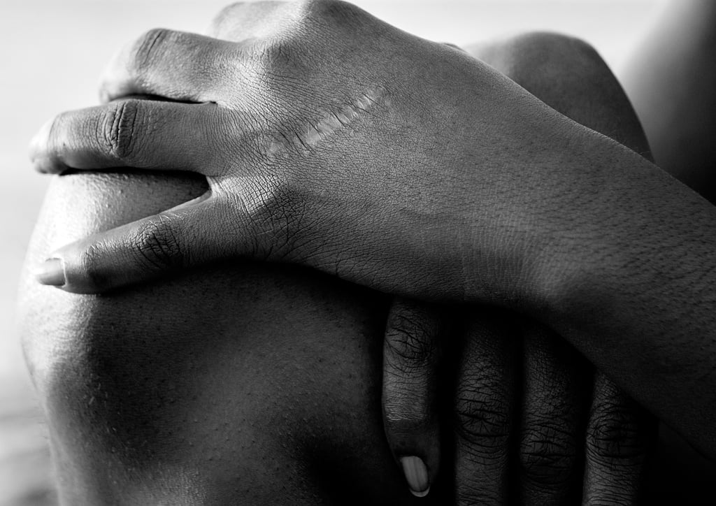 Mains femme noire cicatrice