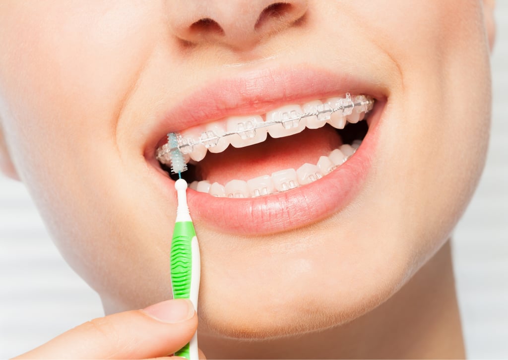 dental-braces-health-care