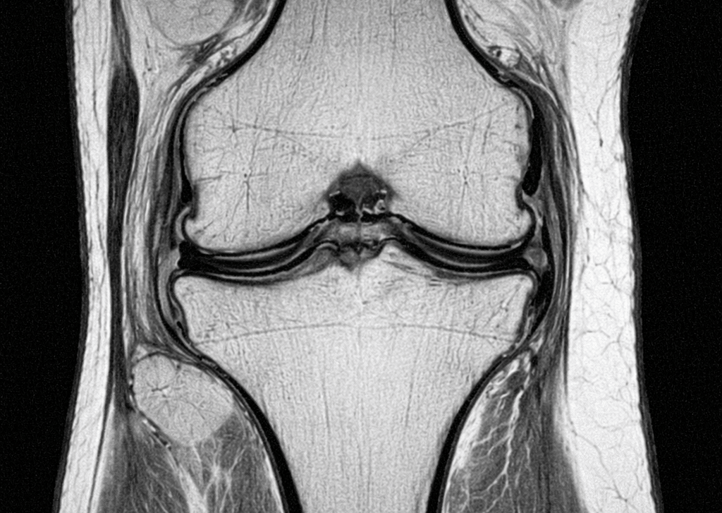 IRM du genou examen imagerie