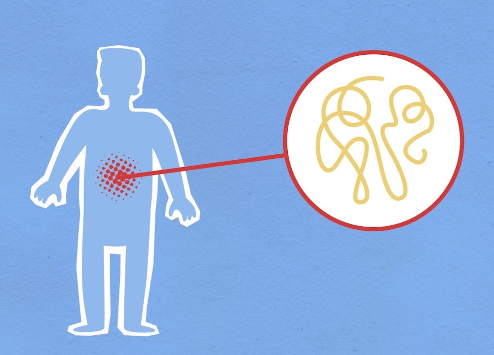 Inflammation Explained: Causes, Symptoms, and Natural Remedies for a Healthier Body