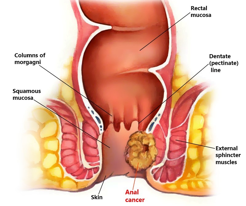 anal cancer