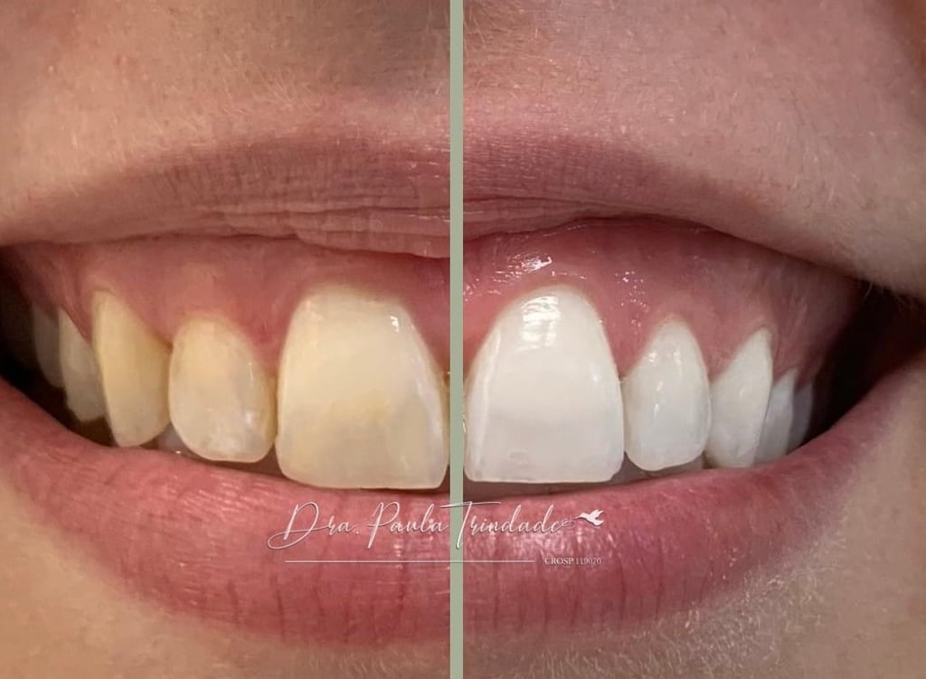 Dra. Paula Trindade - Clareamento dentário - Campinas