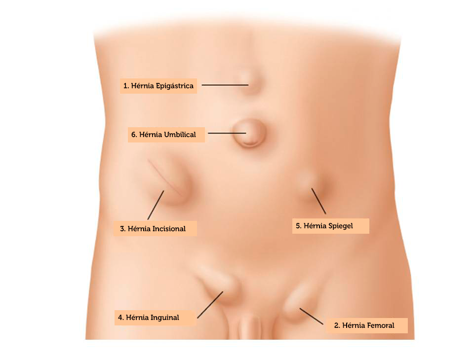paredeabdominal