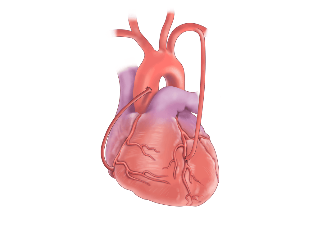 vascular ultrasound coronary artery bypass graft mapping radial surgery heart arm scan imaging perth blocked cabg chest pain