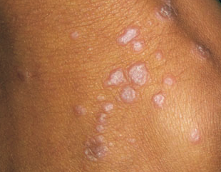 LP skin Disease Lichen Planus
