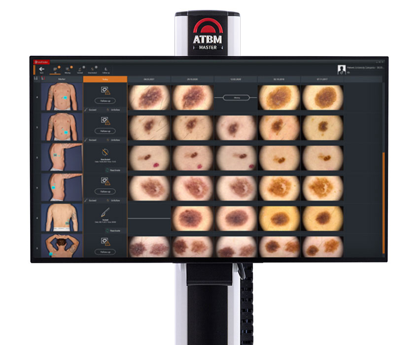 monitorizare alunite videodermatosopie fotofinder