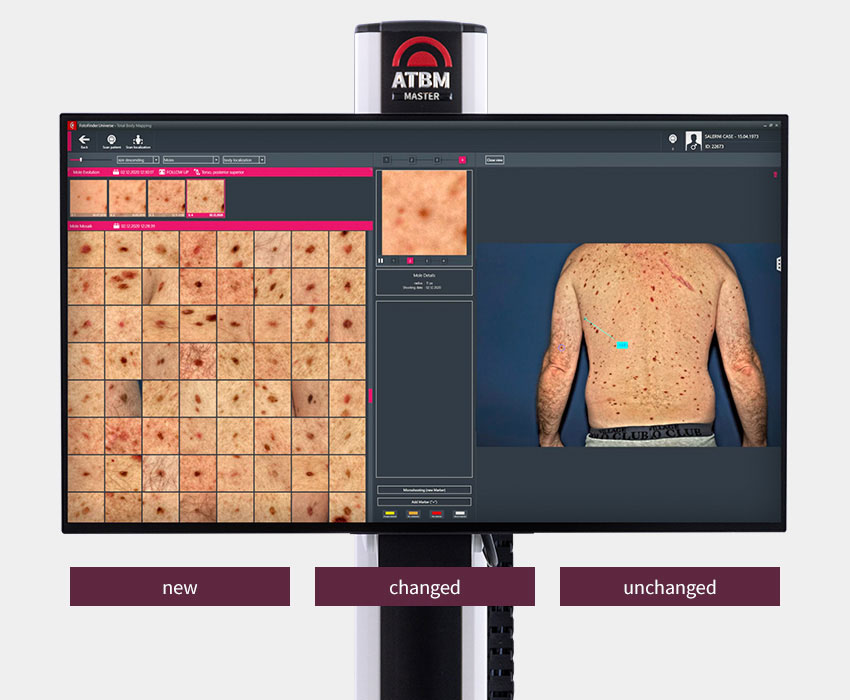 dermatoscopie computerizata Fotofinder