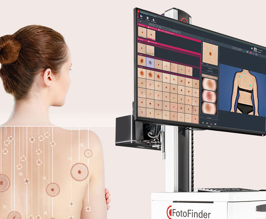 urmarire alunite videodermatoscopie fotofinder