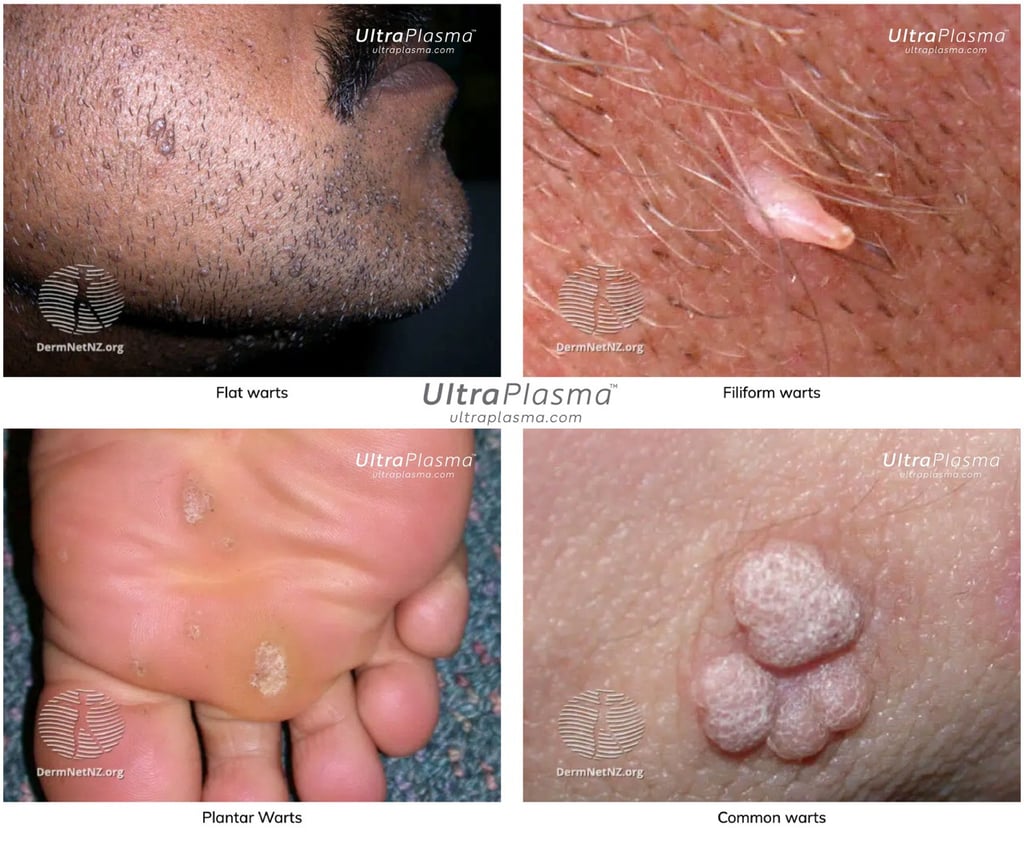 ultraplasma.com_wart_treatment_sigil_tedavisi_ultra_plasma_ultra_plazma_wart_plantar_flat_common