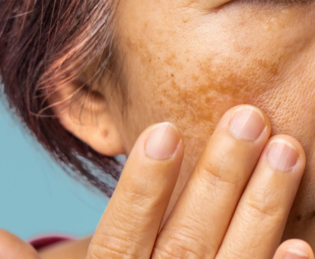 cabinet perma medical : mélasma et tâches pigmentaires