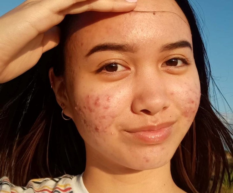 A woman receiving acne treatment in Vadodara, seeking acne scar treatment near her, in Vadodara