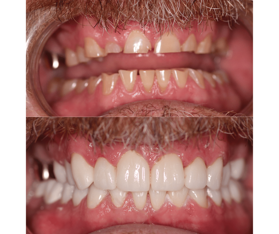 Before and after full mouth rehabilitation 