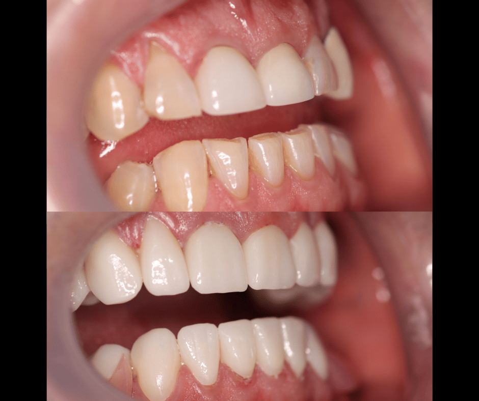 Side view of a before and after full zirconium crowns
