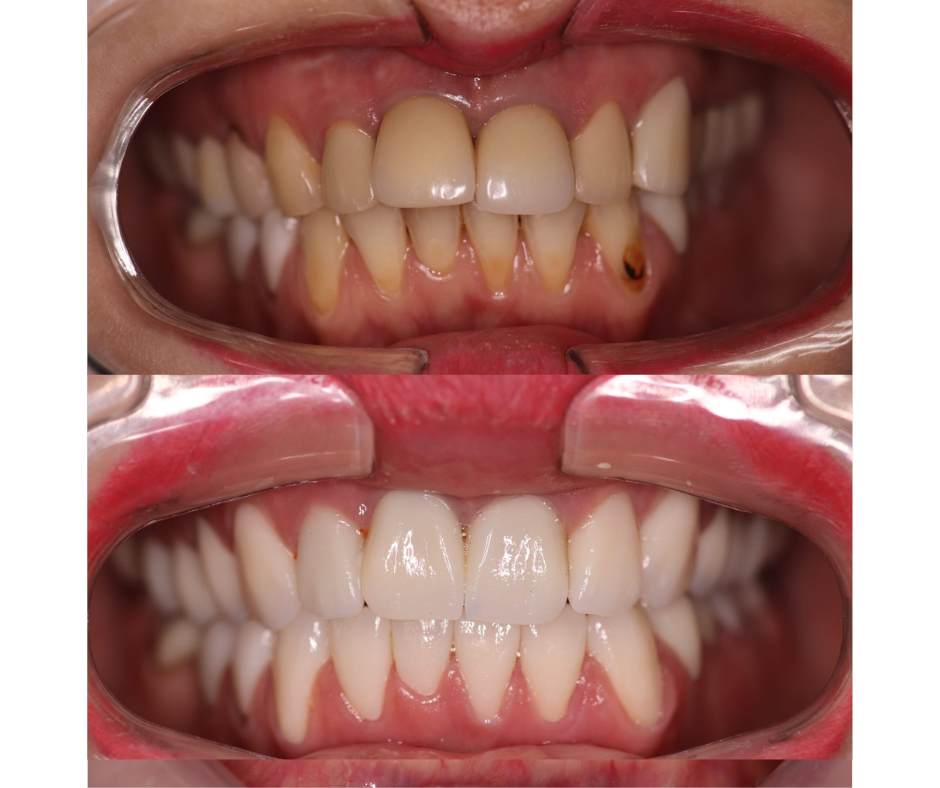 front view of before and after full zirconium crowns
