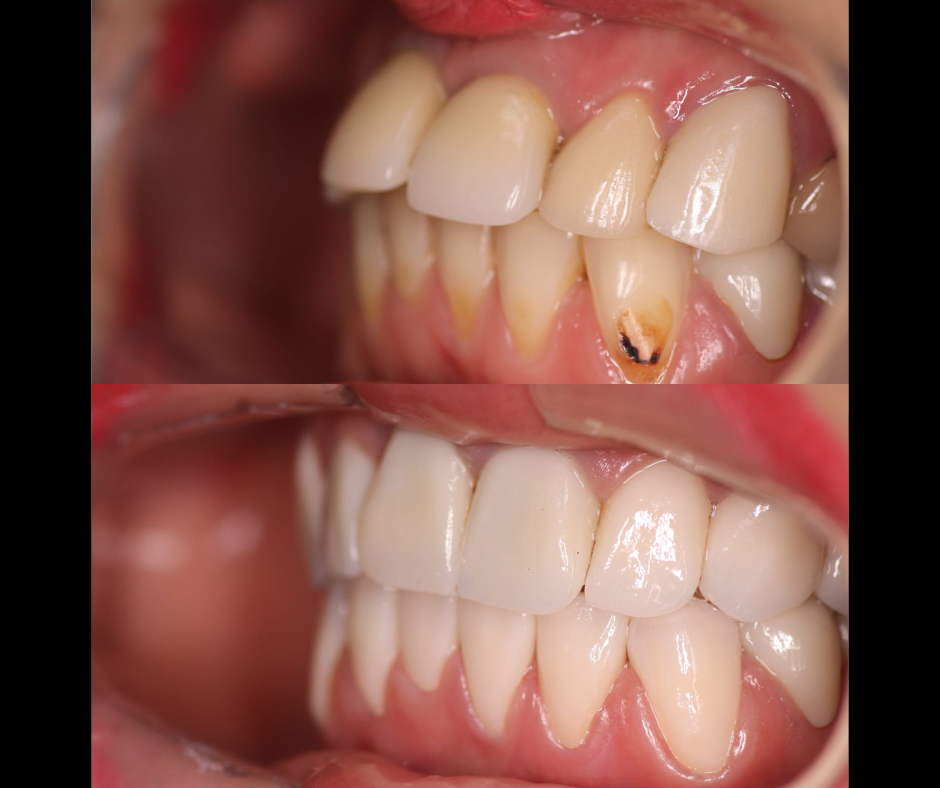front view of before and after full zirconium crowns