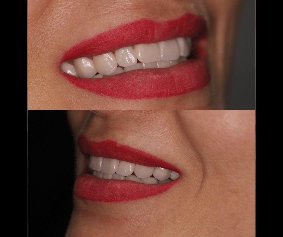 side view of before and after full zirconium crowns