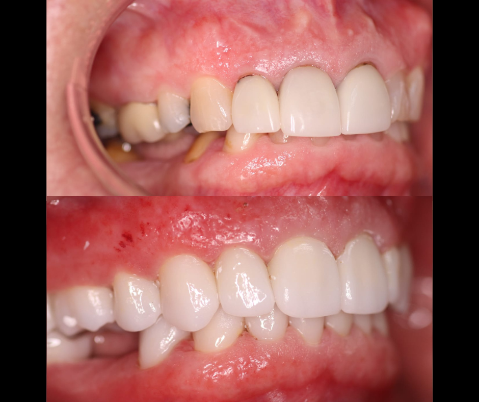 Full Mouth Rehabilitation