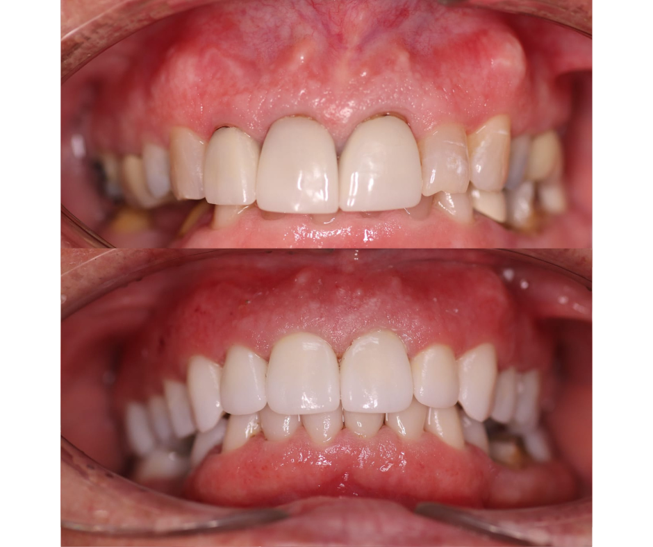 Full Mouth Rehabilitation