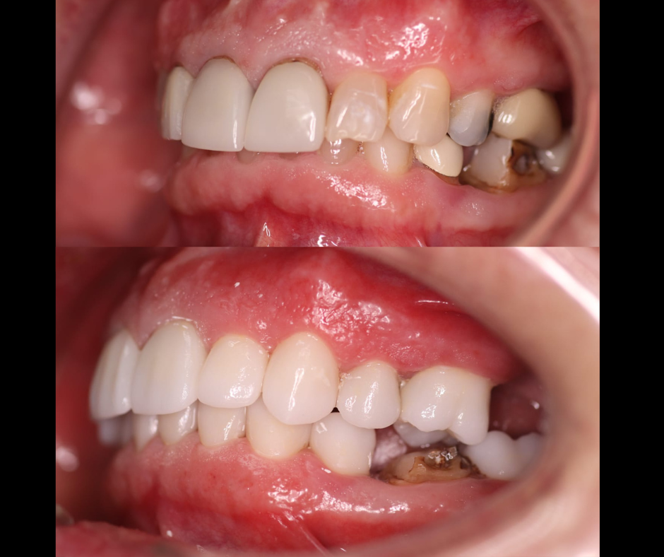 Full Mouth Rehabilitation