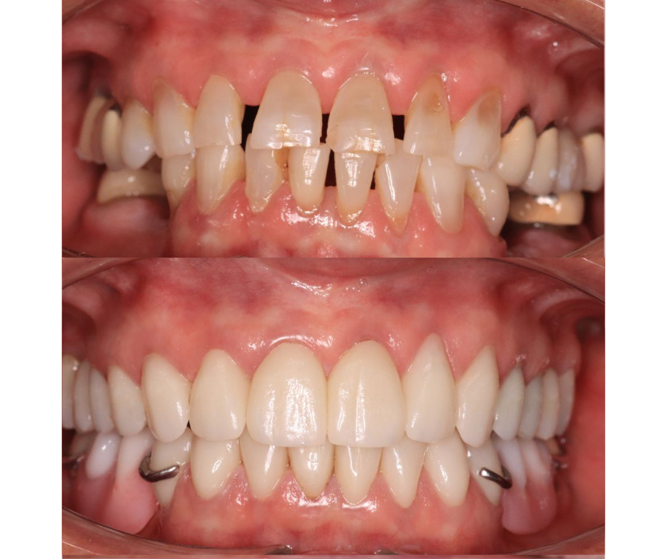 Full Mouth Rehabilitation